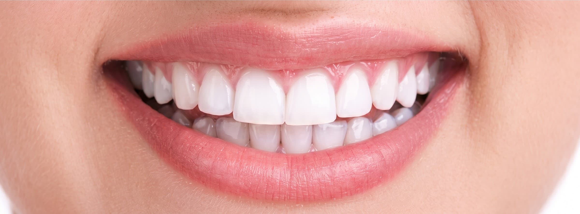 Sonrisa después del blanqueamiento dental