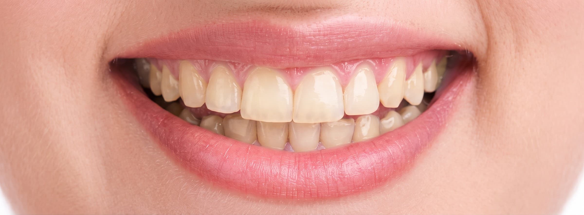 Sonrisa antes del blanqueamiento dental